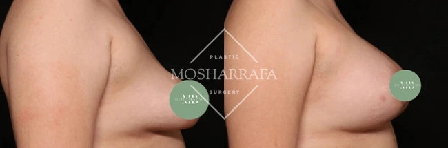 Side profile views of breast augmentation results with measurement markers