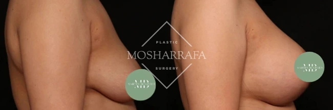 Side profile comparison of breast augmentation results, case 327