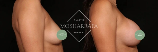 Side profile comparison of breast augmentation results, case 328