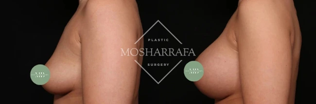 Before and after breast augmentation side view, case 329