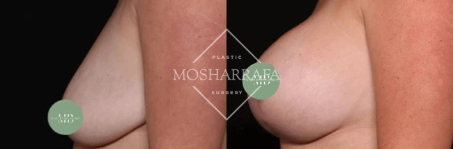Before and after breast augmentation side view, case 330