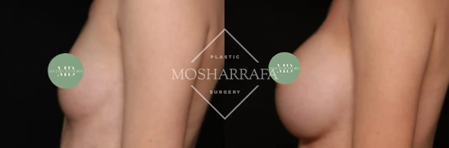 Before and after side profile view of breast augmentation results