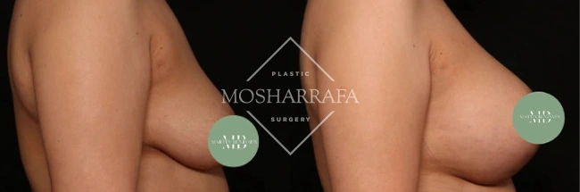 Before and after breast augmentation results showing frontal view