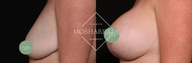 Before and after breast augmentation results showing frontal view