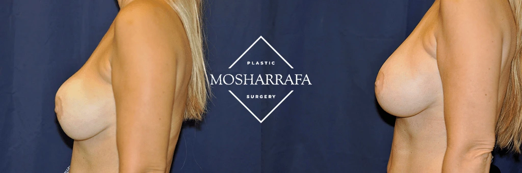 Before and after side profile views of breast augmentation results from Plastic Mosharrafa Surgery