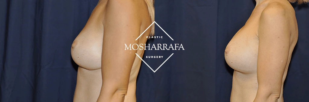Before and after side profile views of breast augmentation results from Plastic Mosharrafa Surgery