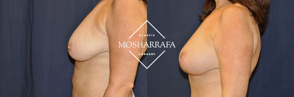 Before and after side profile view of breast augmentation results