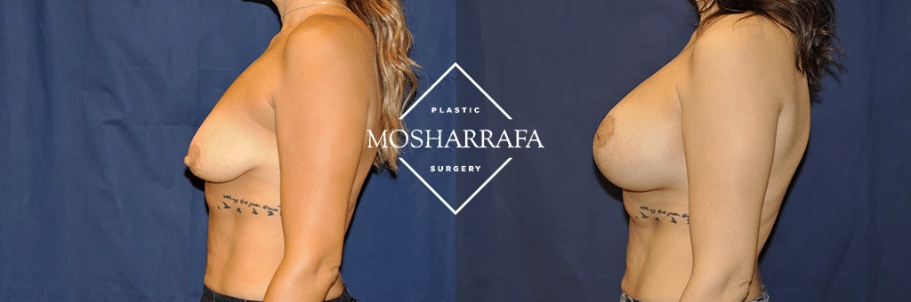 Before and after side view comparison of breast augmentation surgery results