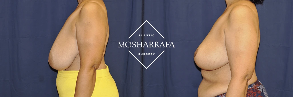 Before and after breast surgery comparison, side view