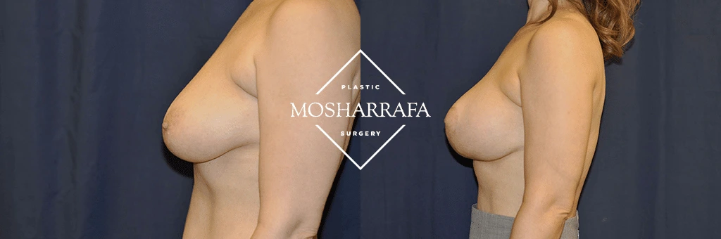 Before and after side profile comparison of breast augmentation results
