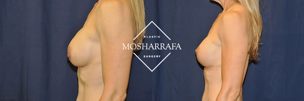 Before and after side profile comparison of breast augmentation surgery results