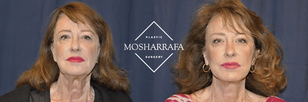 Front and three-quarter facial views of a patient demonstrating results before and after facelift procedure