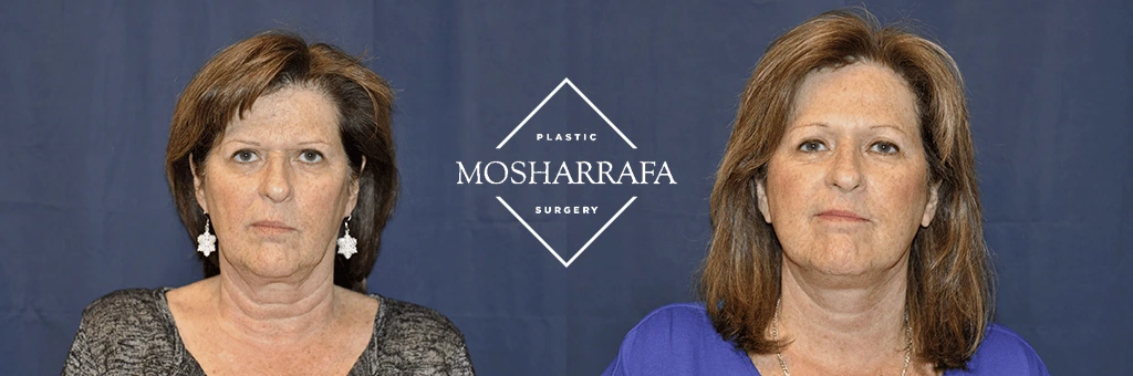 Woman's frontal before-and-after facial appearance comparison