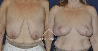 Before and after breast lift, front view