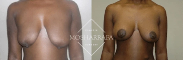Before and after front view comparison of breast augmentation results