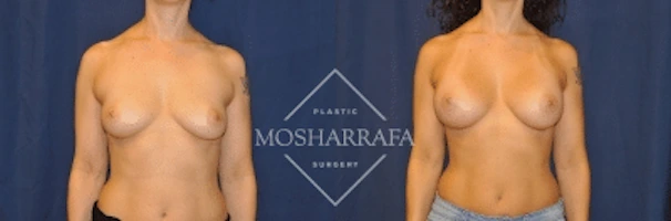 Before and after breast augmentation surgery, frontal view