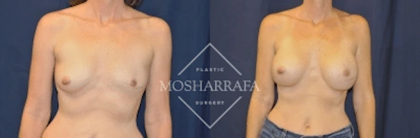Before and after frontal view of breast augmentation results