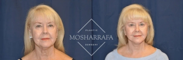 Woman's frontal before-and-after facial appearance comparison