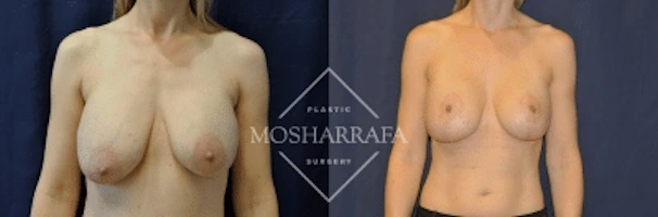 Breast augmentation before and after, front view comparison