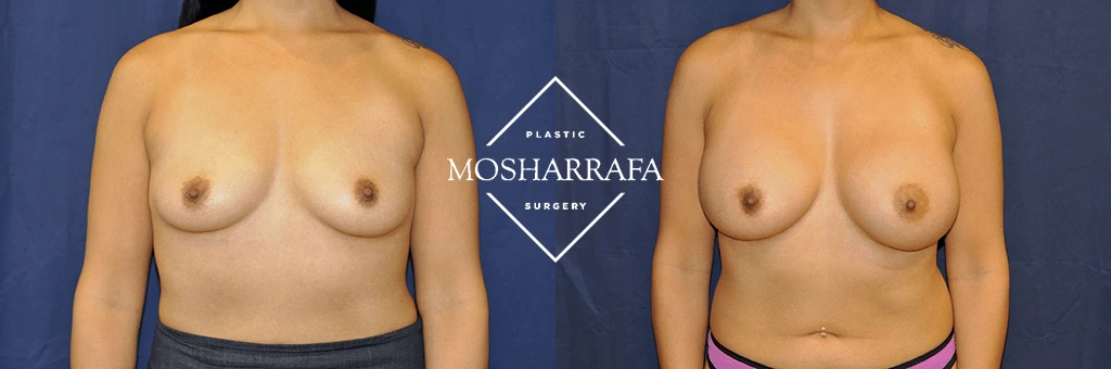 Breast augmentation before and after, front view comparison