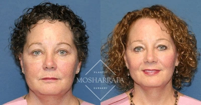 Before and after frontal facial comparison showing skin texture and contour improvements