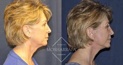 Before and after side profile views demonstrating facial contour and skin texture improvements