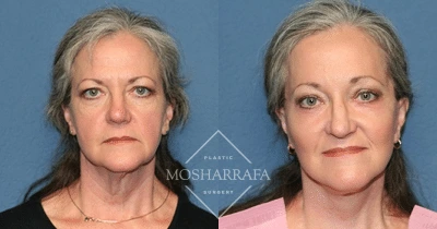 Before and after frontal views of a patient showing facial refinement and skin quality improvement