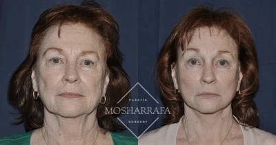 Before and after frontal view of female patient showing facial rejuvenation results