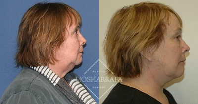 Before and after profile view of female patient showing facial reshaping results