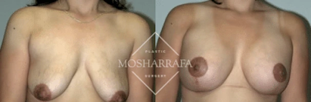 Before and after breast surgery results, frontal view