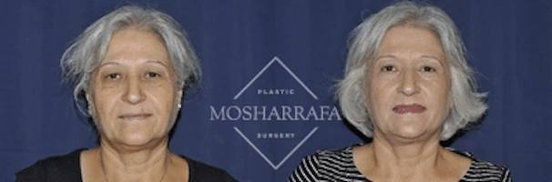 Before and after frontal views of patient's face showing facial rejuvenation results
