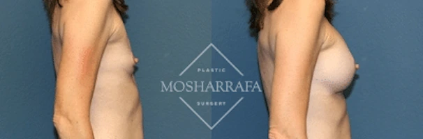 Before and after side profile comparison of breast augmentation results