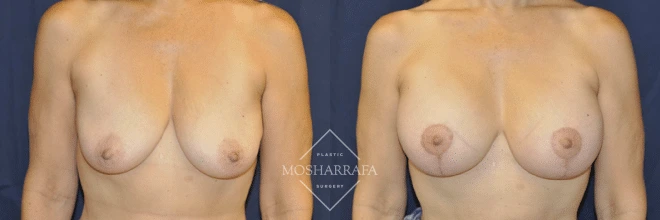 Before and after front view of breast augmentation results