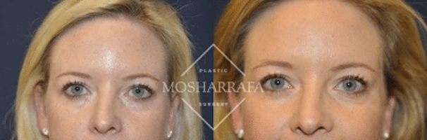 Before and after frontal facial views showing case 184 results