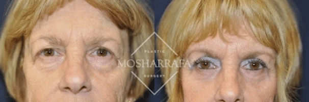 Before and after frontal facial views showing case 185 results
