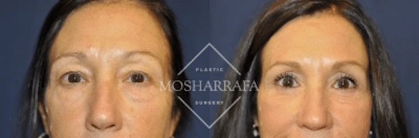 Front-facing before and after comparison of patient's facial appearance and skin texture