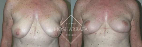 Before and after breast surgery comparison, frontal view
