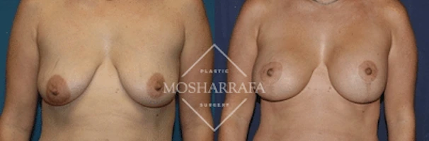 Before and after front view showing breast augmentation results