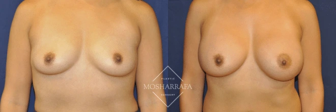 Before and after front view comparison of breast augmentation results