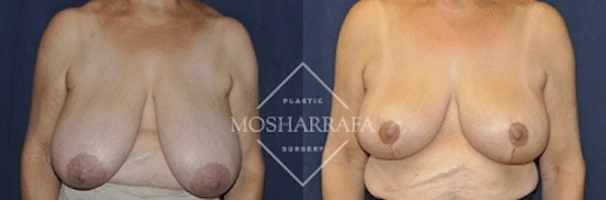Before and after frontal view of breast surgery results