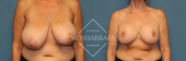 Before and after frontal view of breast augmentation results