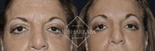Before and after frontal view of patient's eyes and mid-face region