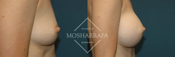 Before and after side view of breast augmentation results