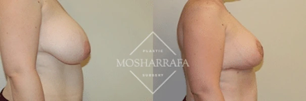 Before and after side view of breast augmentation results