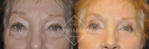 Before and after front-facing eye area comparison showing facial refinement