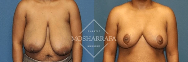 Breast reduction surgery before and after, front view comparison