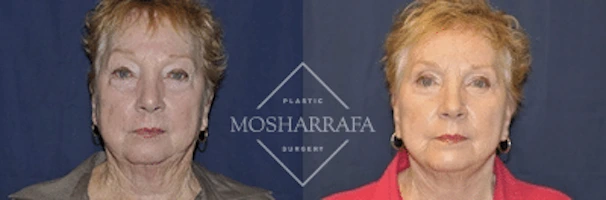 Before and after frontal views of a patient's face