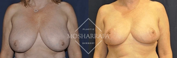 Breast lift surgery before and after, front view comparison