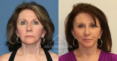 Before and after frontal views of a patient's face
