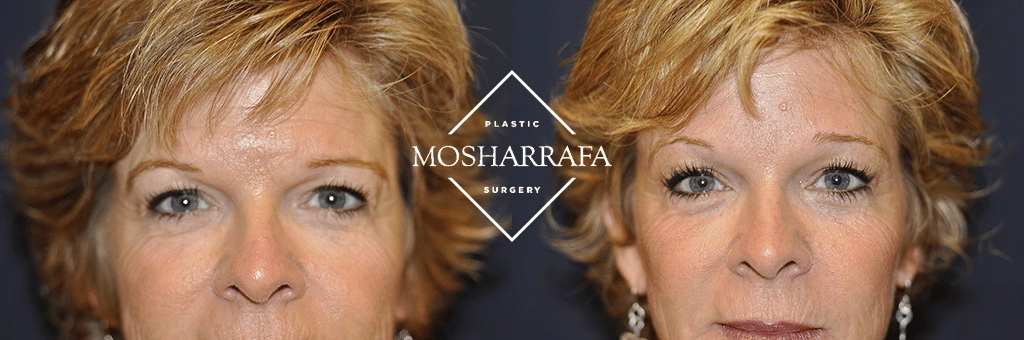 Before and after front-facing comparison showing facial rejuvenation and contouring